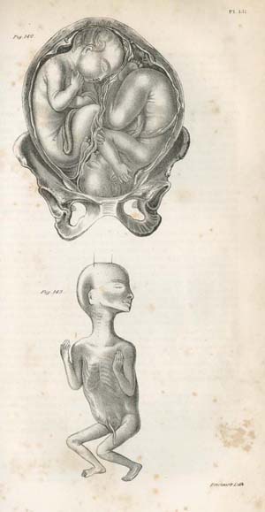 Pl. LII. “Twins in utero: the head of one presenting, the breech of the other; Secondary foetus three months of age.” Plate printed by Thomas Sinclair in Francis H. Ramsbotham, The Principles and Practice of Obstetric Medicine and Surgery, in Reference to the Process of Parturition. Illustrated by One Hundred and Forty-Eight Plates (Philadelphia: Lea & Blanchard, 1849). 