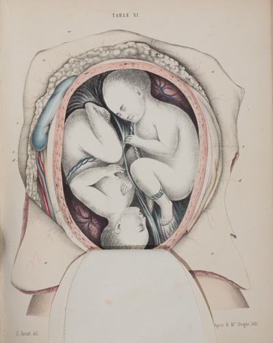 G. Spratt, Obstetric Tables (Philadelphia: James A. Bill, 1850). Hand-colored lithographed illustration showing twin fetuses.